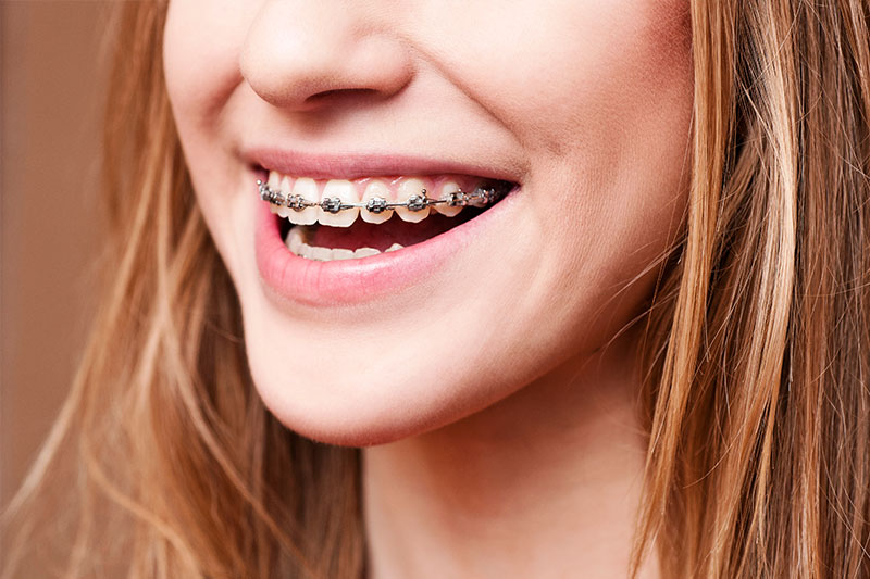 Orthodontics in Holland